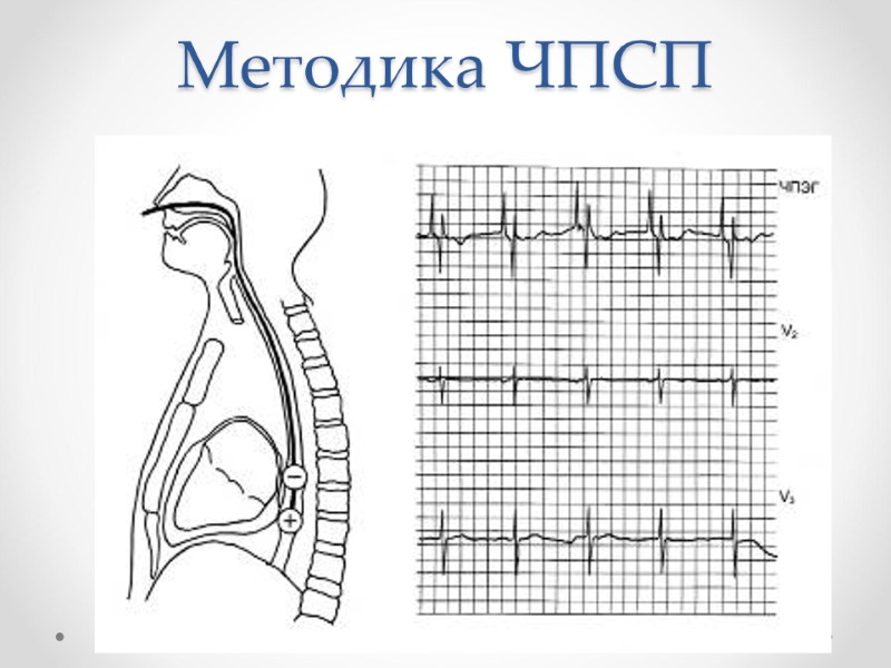 Методика ЧПСП Методика ЧПСП